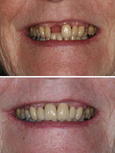 Replacement of failed front tooth with implant retained crown