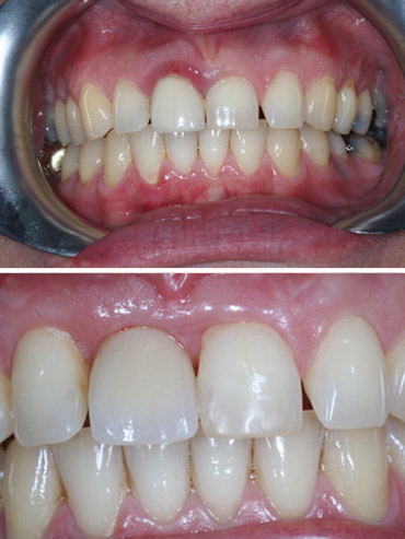 Replacement of failed right front tooth with implant retained crown
