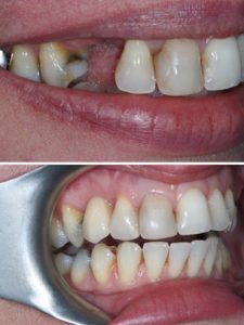 Replacement of right canine tooth with implant retained crown