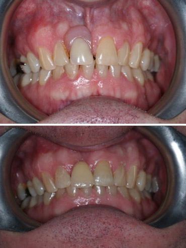 Replacement of a denture with a fixed adhesive bridge