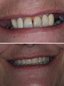 Replacement of failing upper teeth with full arch implant bridge